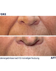 Dr. Noxton®- Anti Falten Tape- Full Face
