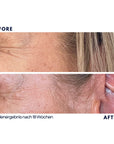 Dr. Noxton®- Anti Falten Tape- Full Face