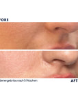 Dr. Noxton®- Anti Falten Tape- Krähenfüße & Nasolabialfalten