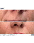 Dr. Noxton®- Anti Falten Tape- Full Face